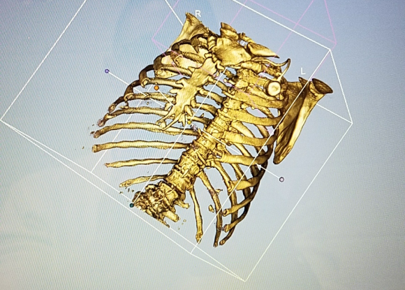 Human Torso Skeleton CT Scan (Sample)